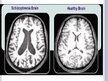 Presentations 'Schizophrenia', 9.